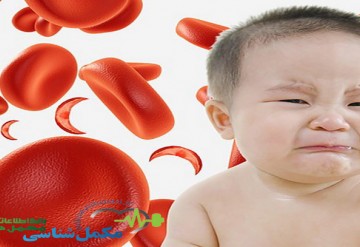 ارتباط بین هورمون اریتروفرون و وضعیت آهن در کودکان مبتلا به کم خونی