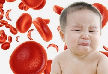 نقش ویتامین A در مدیریت کم خونی ناشی از کمبود آهن در کودکان