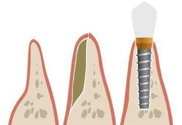 آیا سطح بالای کلسترول یا کمبود ویتامین D خطری برای ایمپلنت های دندانی یا پیوند استخوان ایجاد می کند؟